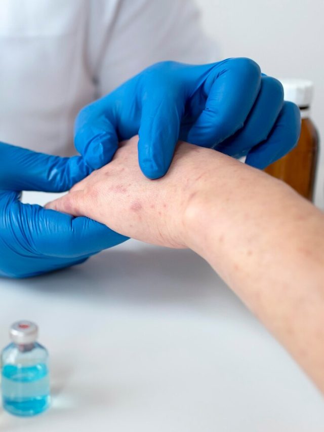 monkeypox-virus-rapid-test