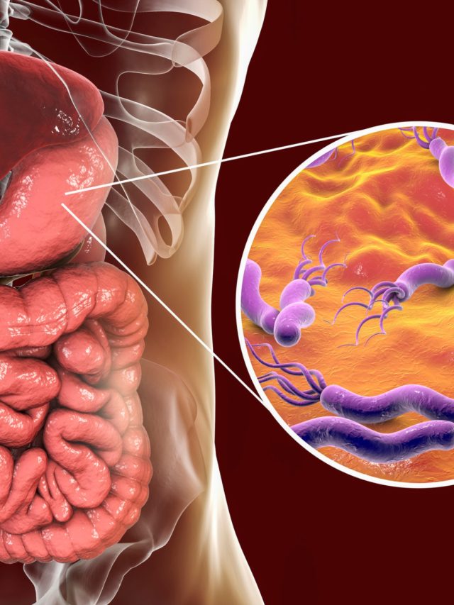 H. Pylori infection